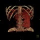 Duplex kidney: CT - Computed tomography